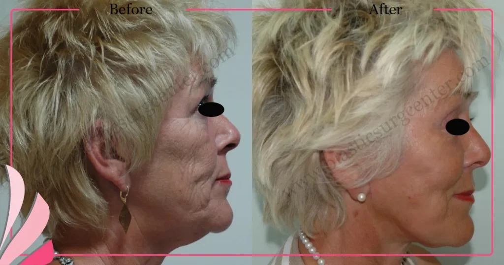 Facelift before and after - Case 23, Right Profile