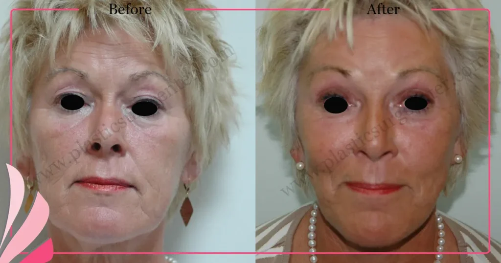 Facelift before and after - Case 23, Front View
