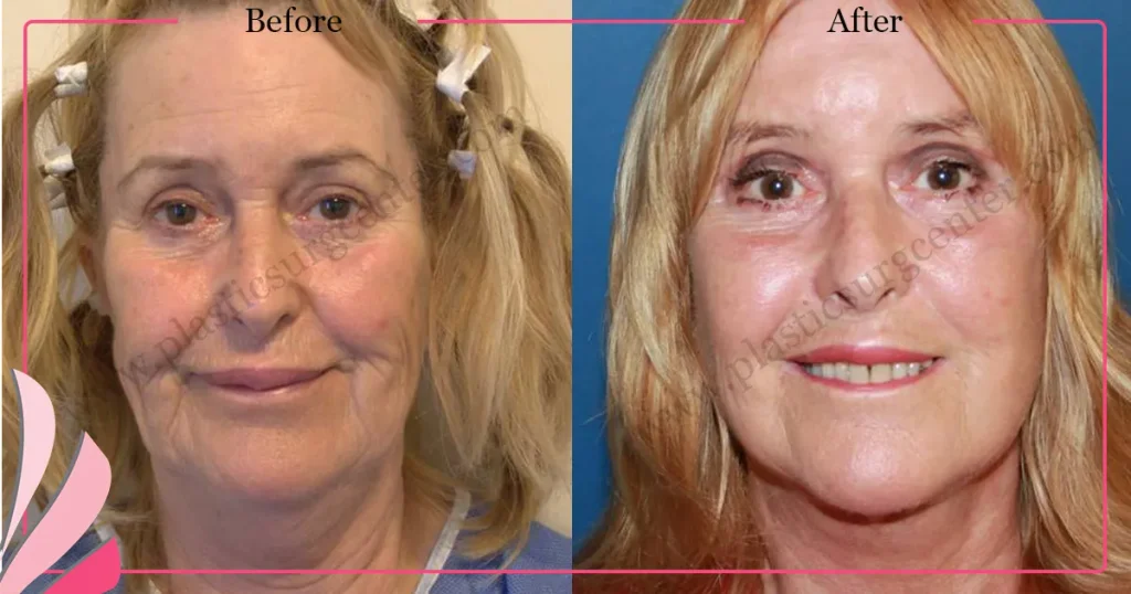 Facelift before and after - Case 24, Front View