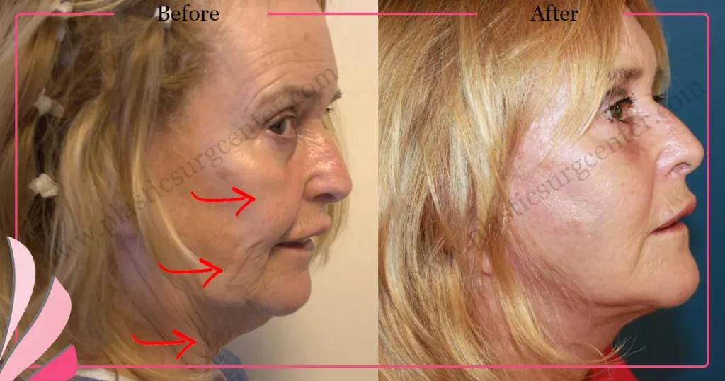 Facelift before and after - Case 24, Right Profile