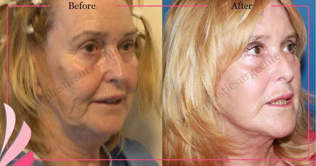 Facelift before and after - Case 24, Right Oblique view