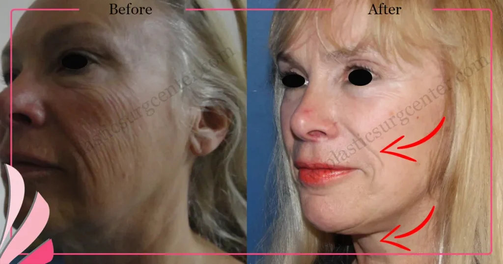 Facelift before and after - Case 25, Oblique view