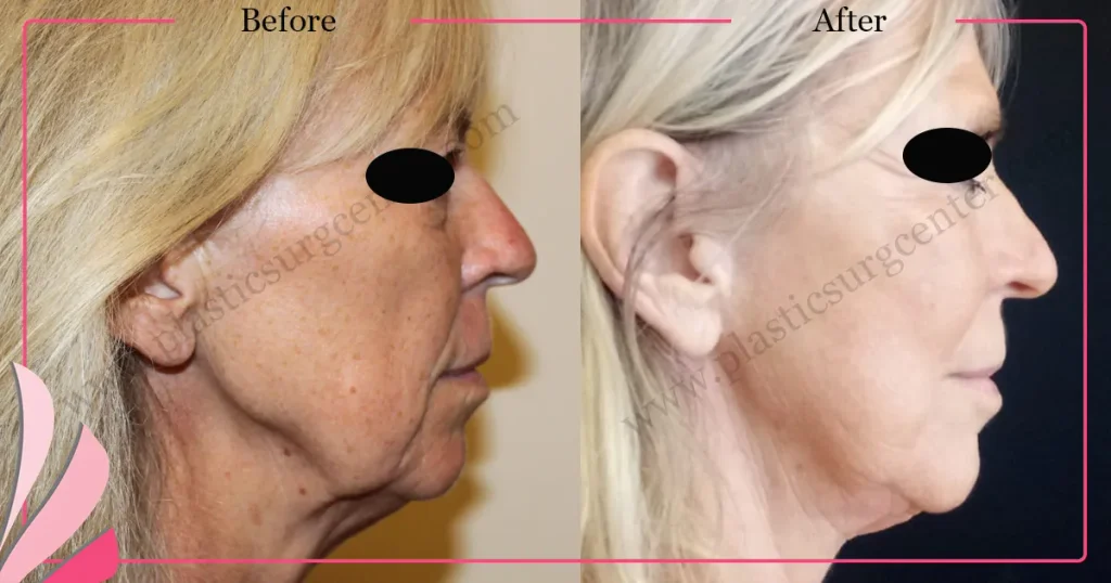 Facelift before and after - Case 26, Right Profile