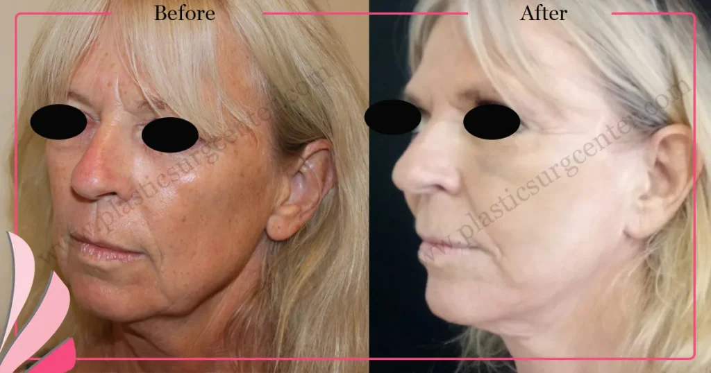 Facelift before and after - Case 26, Oblique view