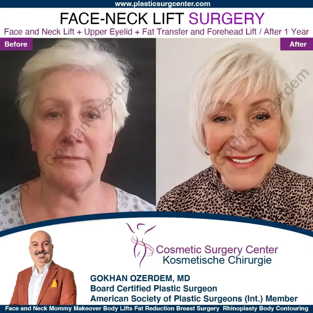 Facelift before and after - Case 3, Front View