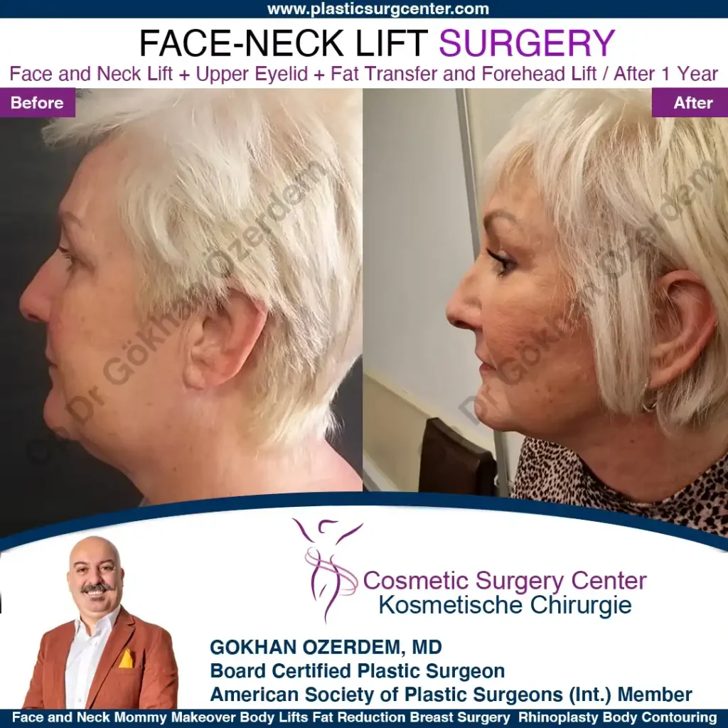 Facelift before and after - Case 3, Left Profile