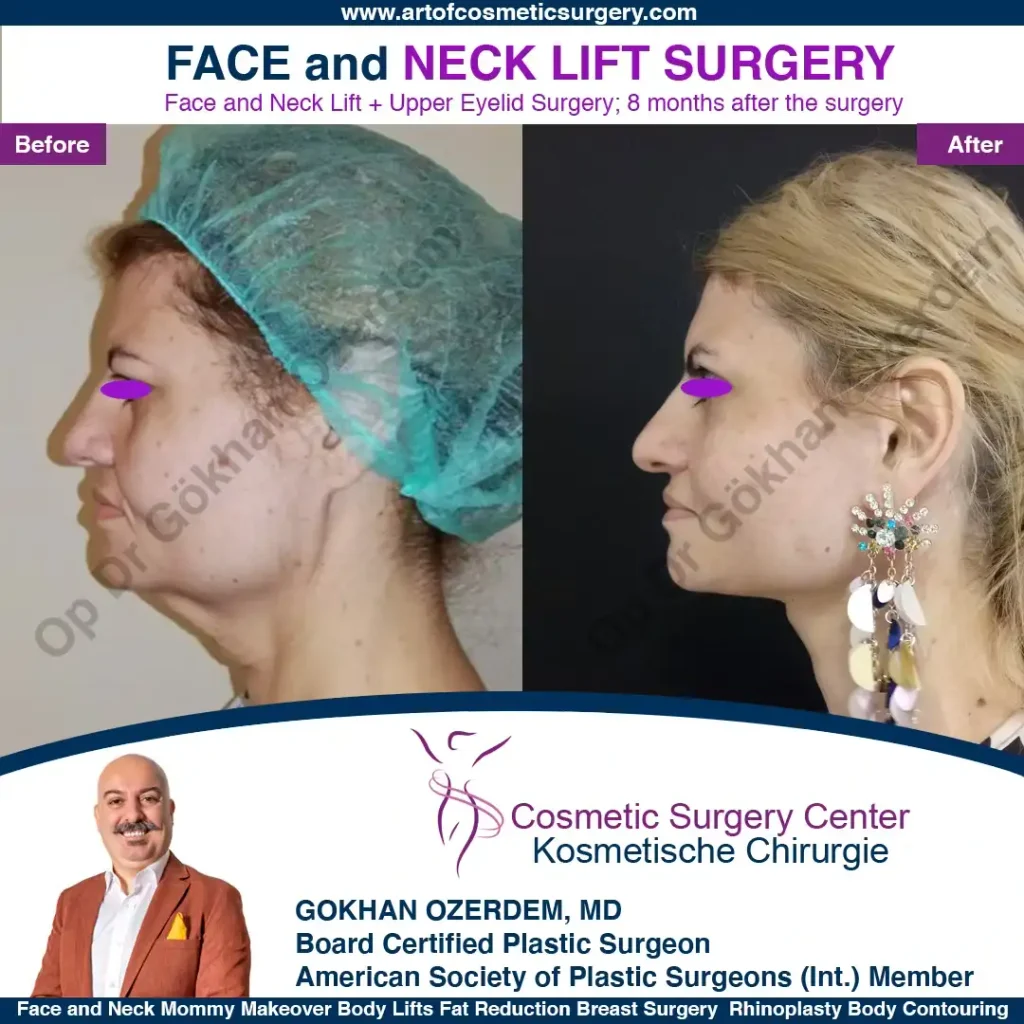 Facelift before and after - Case 2, Left Profile