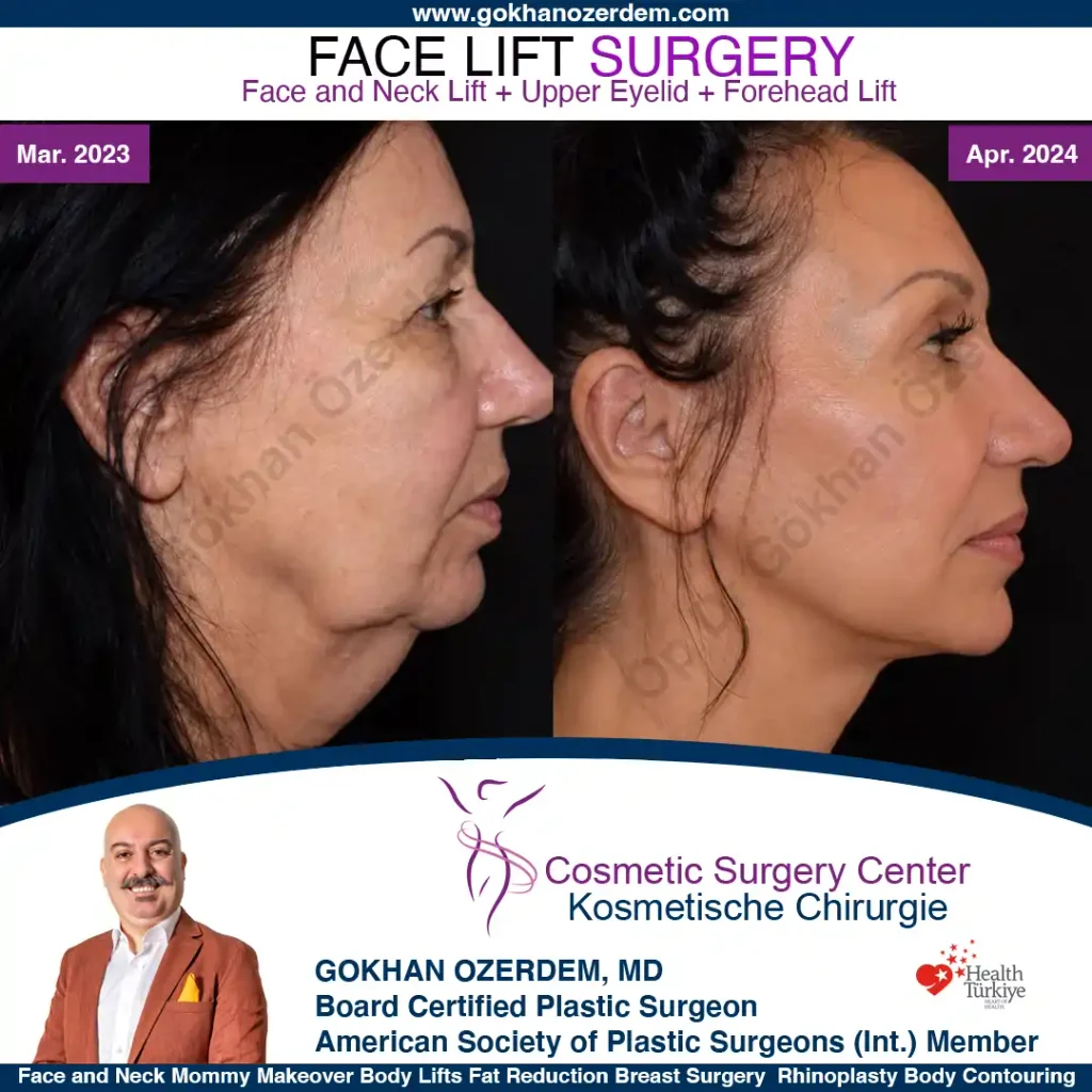 Facelift before and after - Case 27, Right Profile