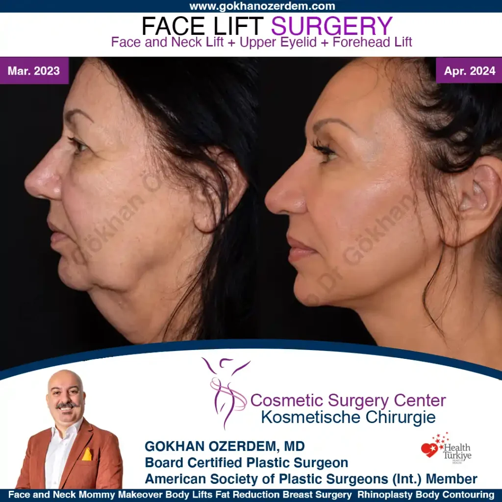 Facelift before and after - Case 27, Left Profile