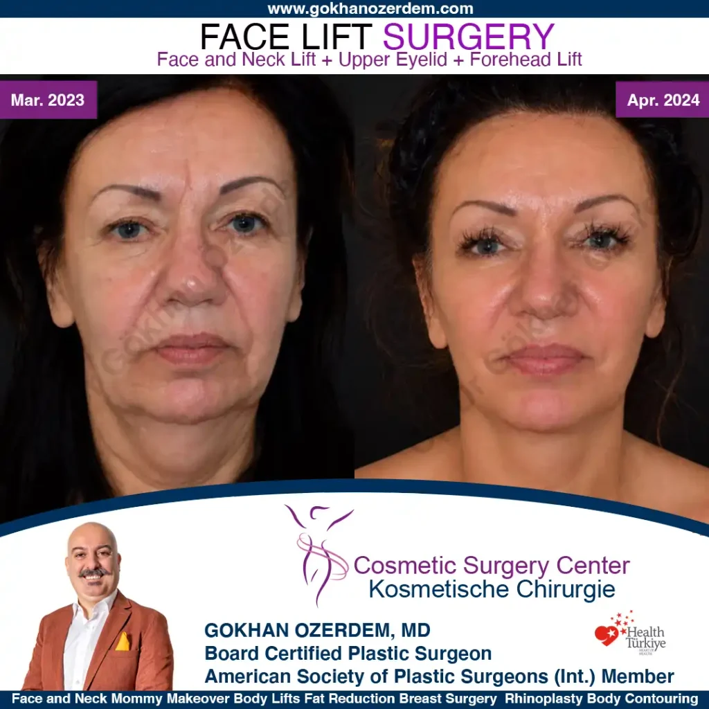 Facelift before and after - Case 27, Front View