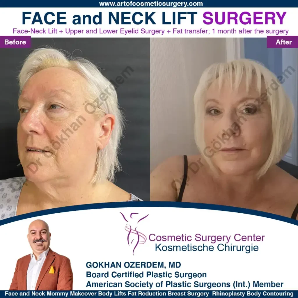 Facelift before and after - Case 7, Left Profile