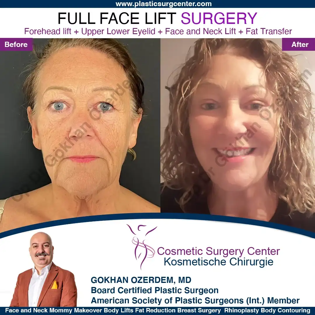 Facelift before and after - Case 4, Front View