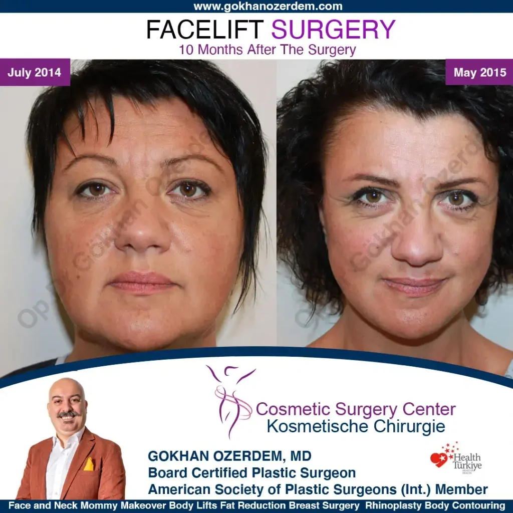Facelift before and after - Case 1, Front View