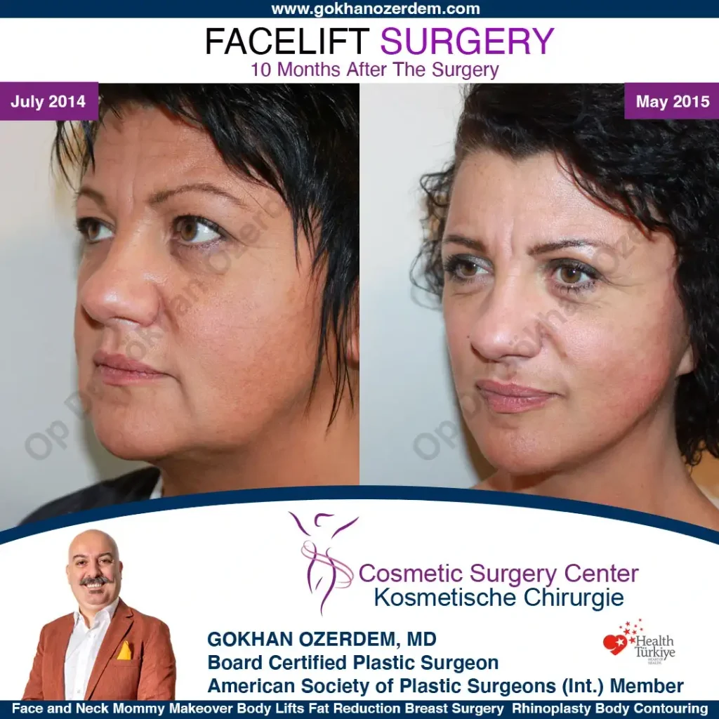 Facelift before and after - Case 1, Oblique view