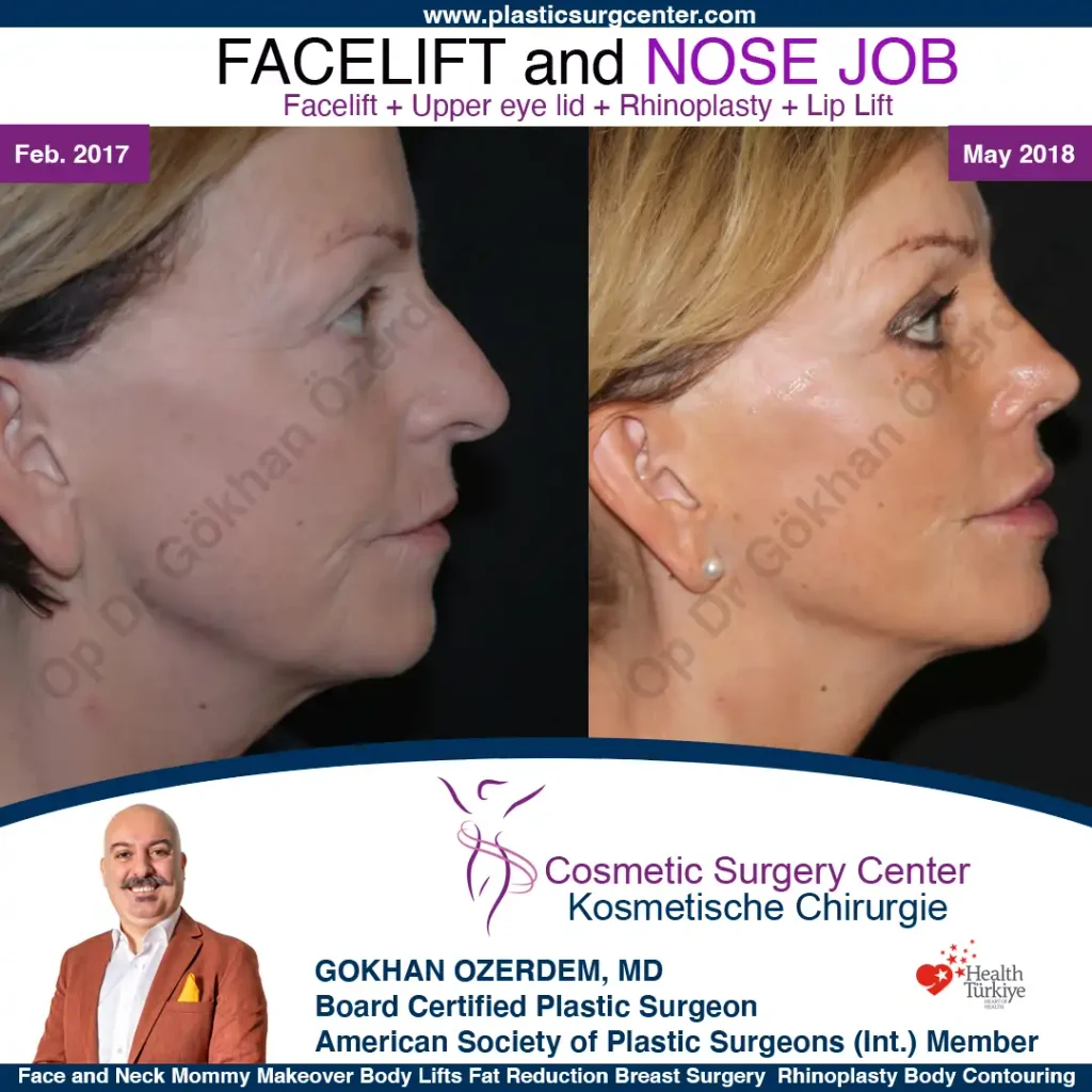 Facelift before and after - Case 28, Right Profile