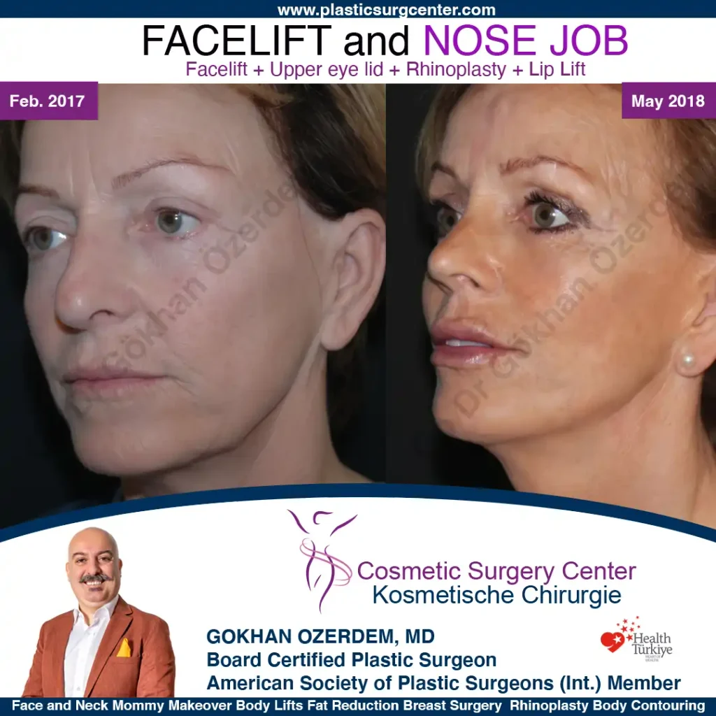 Facelift before and after - Case 28, Oblique View