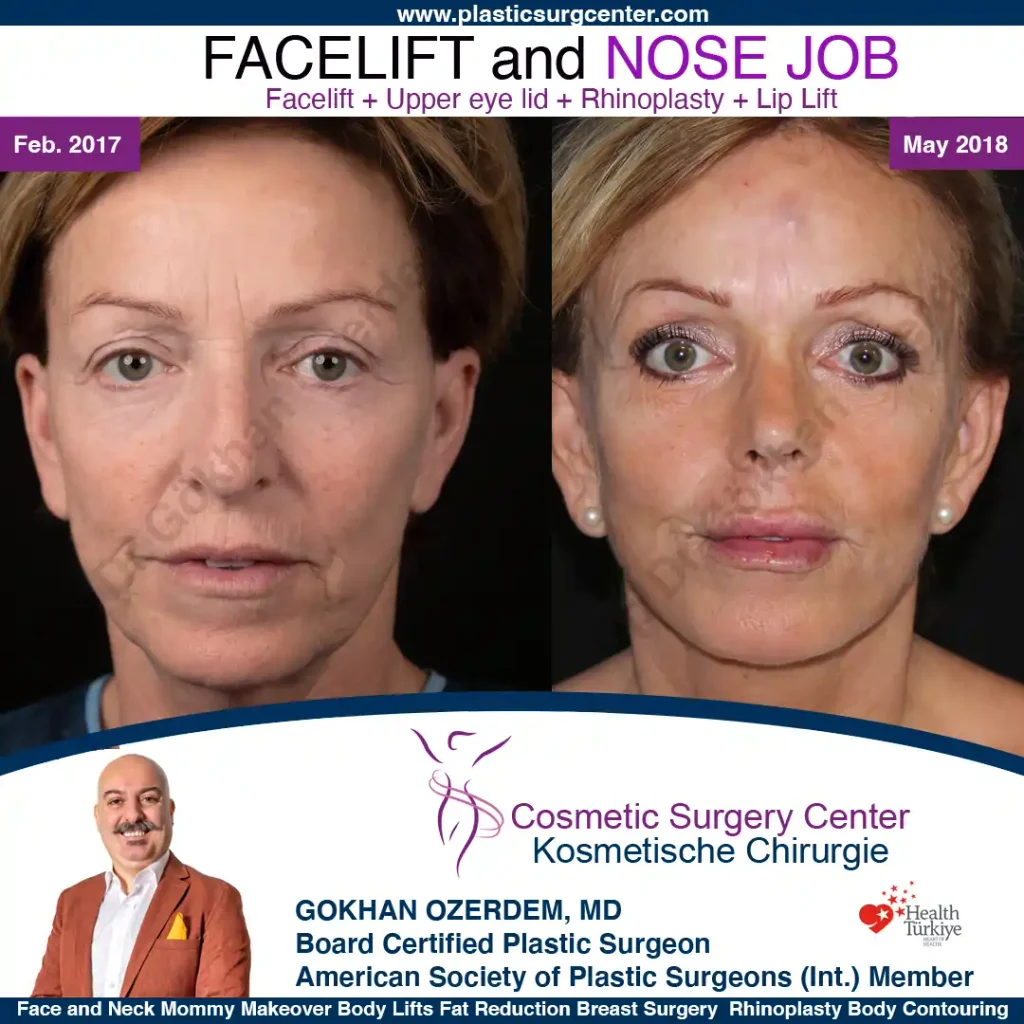 Facelift before and after - Case 28, front view