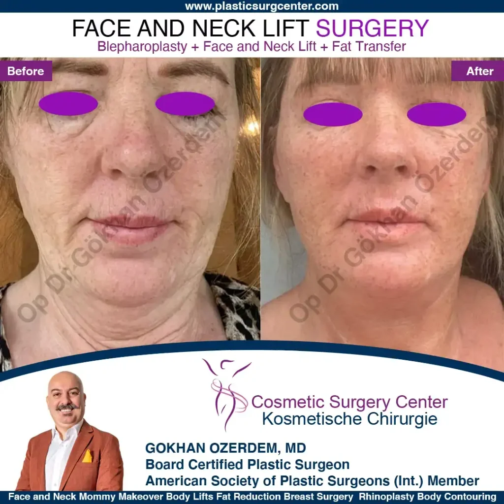 Facelift before and after - Case 5, Front View