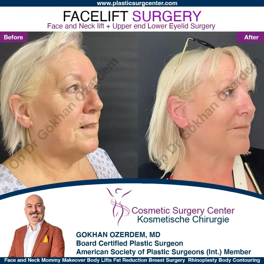 Facelift before and after - Case 7, Oblique view