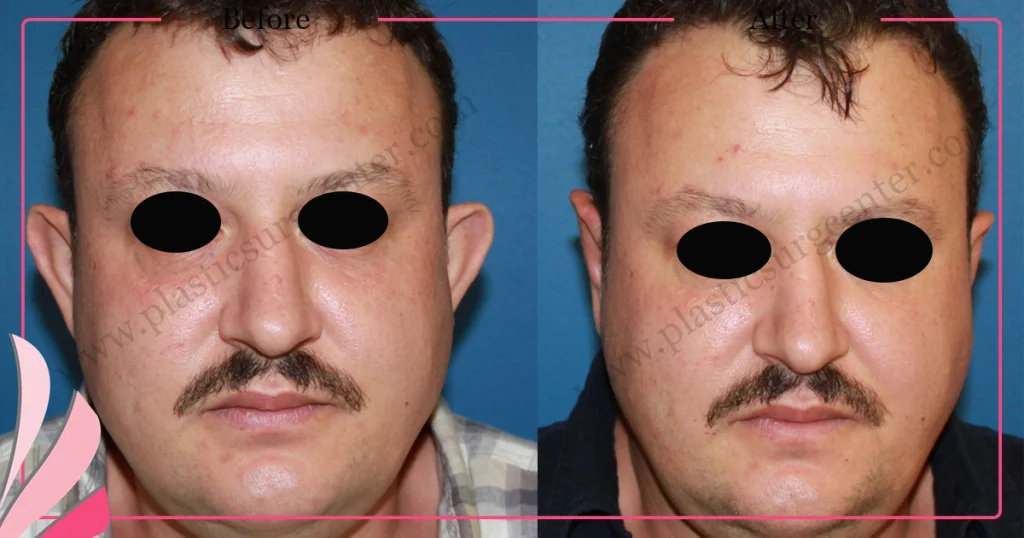 Otoplasty, Prominent ear surgery - Case 4 - Front View