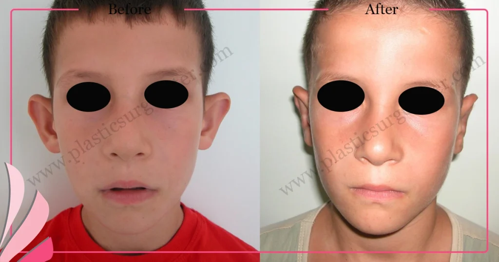 Otoplasty, Prominent ear surgery - Case 2 - Front View