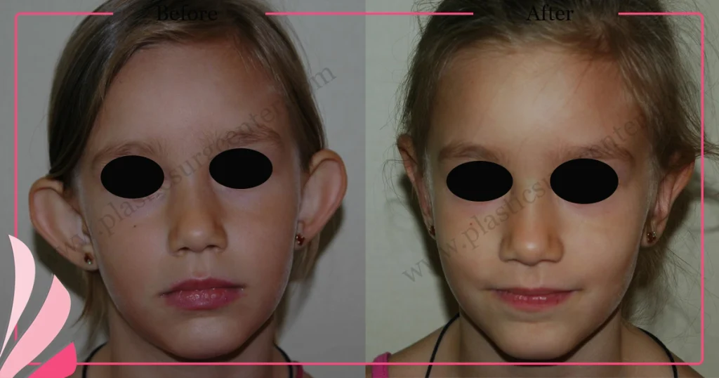 Otoplasty in Turkey Antalya - Case 1 - Front view