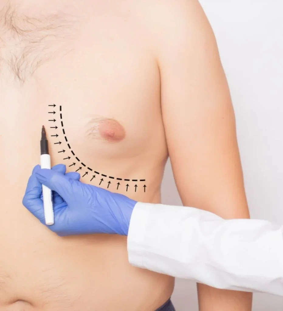 Gynecomastia in Turkey, Antalya