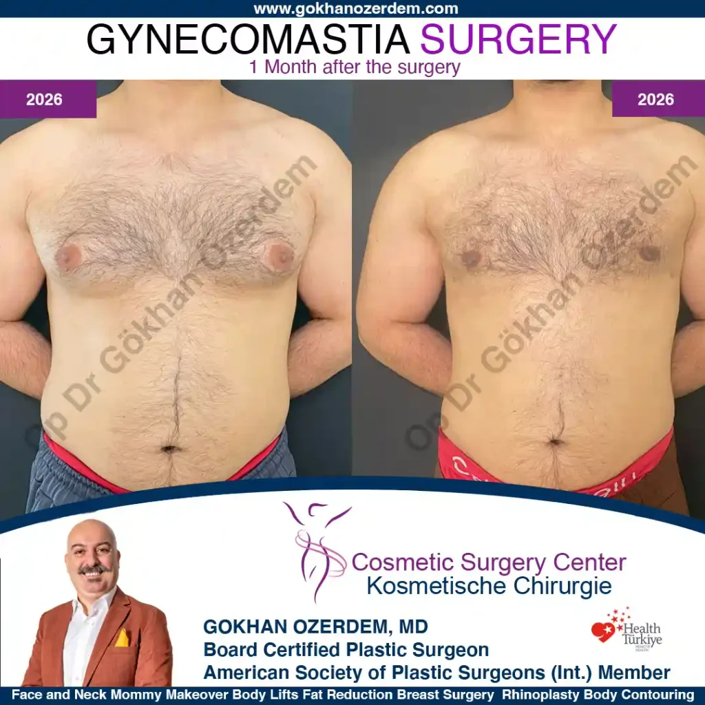 Gynecomastia in Turkey, Case 1 - Front View