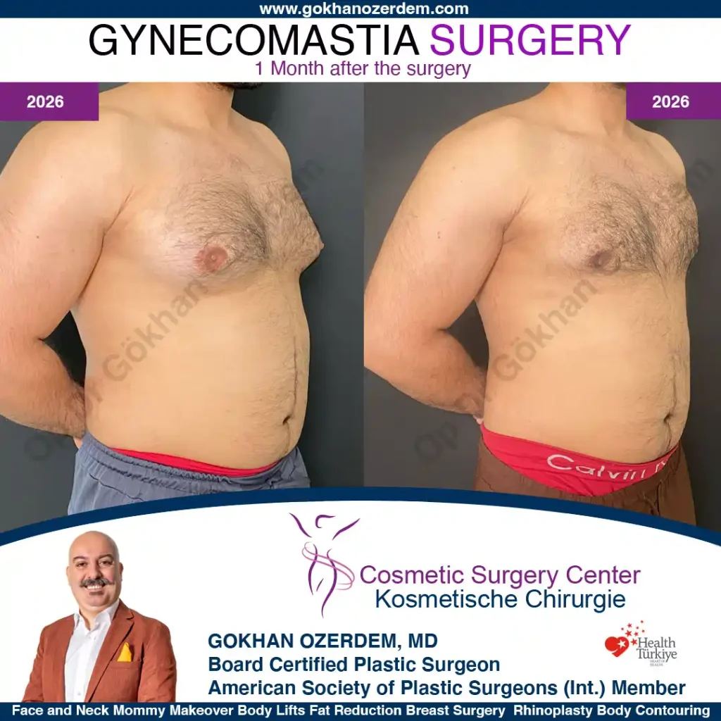 Gynecomastia in Turkey, Case 1 - Oblique View