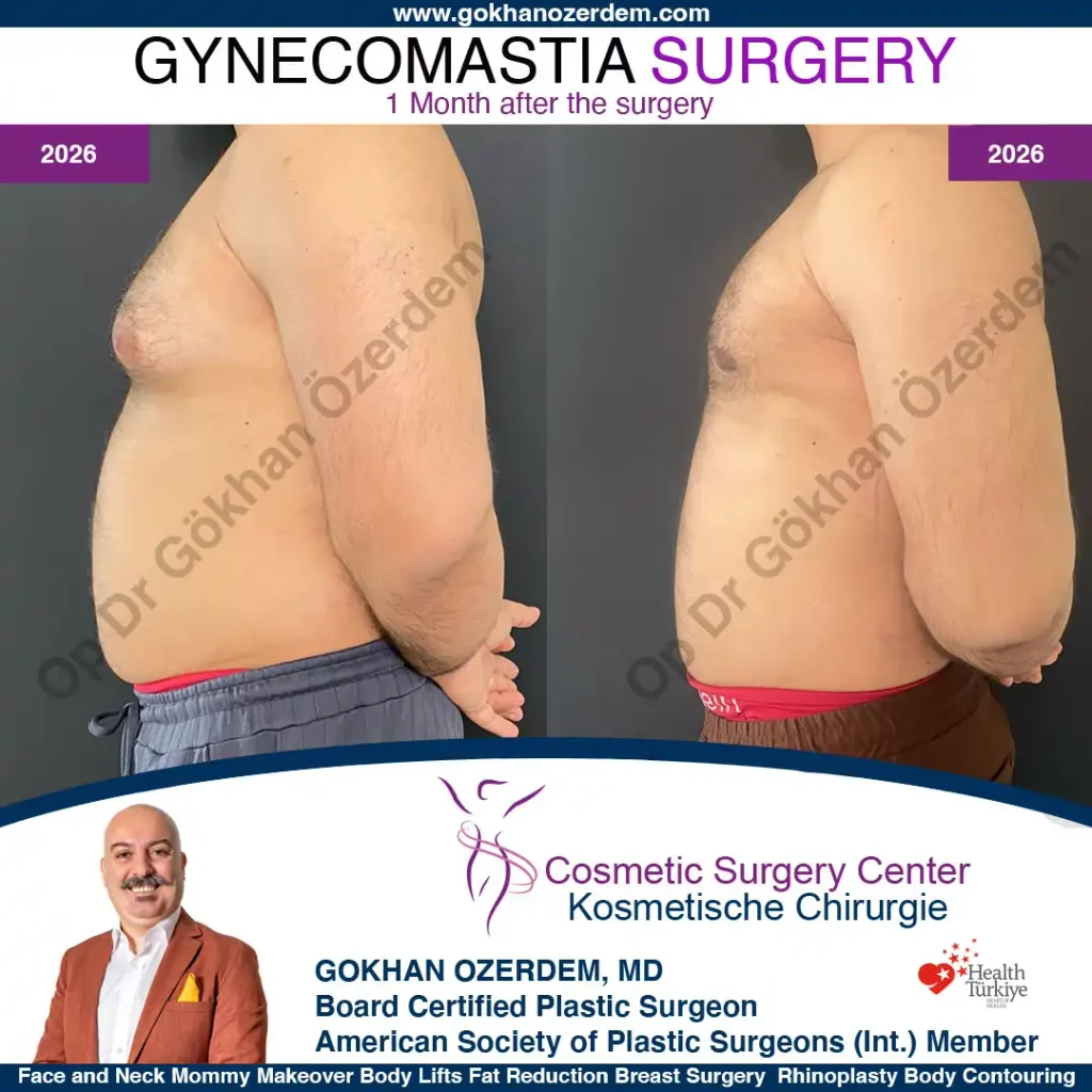 Gynecomastia in Turkey, Case 1 - Right Side