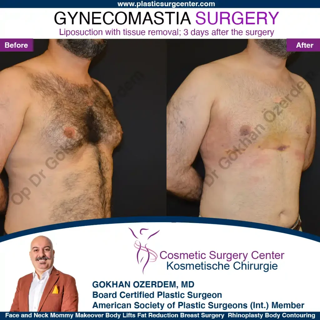 Gynecomastia in Turkey, Case 2 - Oblique View