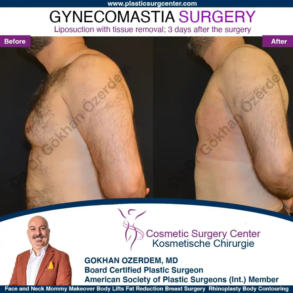 Gynecomastia in Turkey, Case 2 - Right Side
