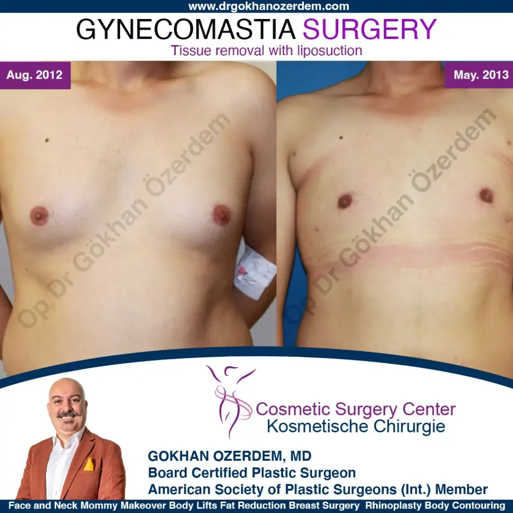 Gynecomastia in Turkey, Case 5 - Front Side