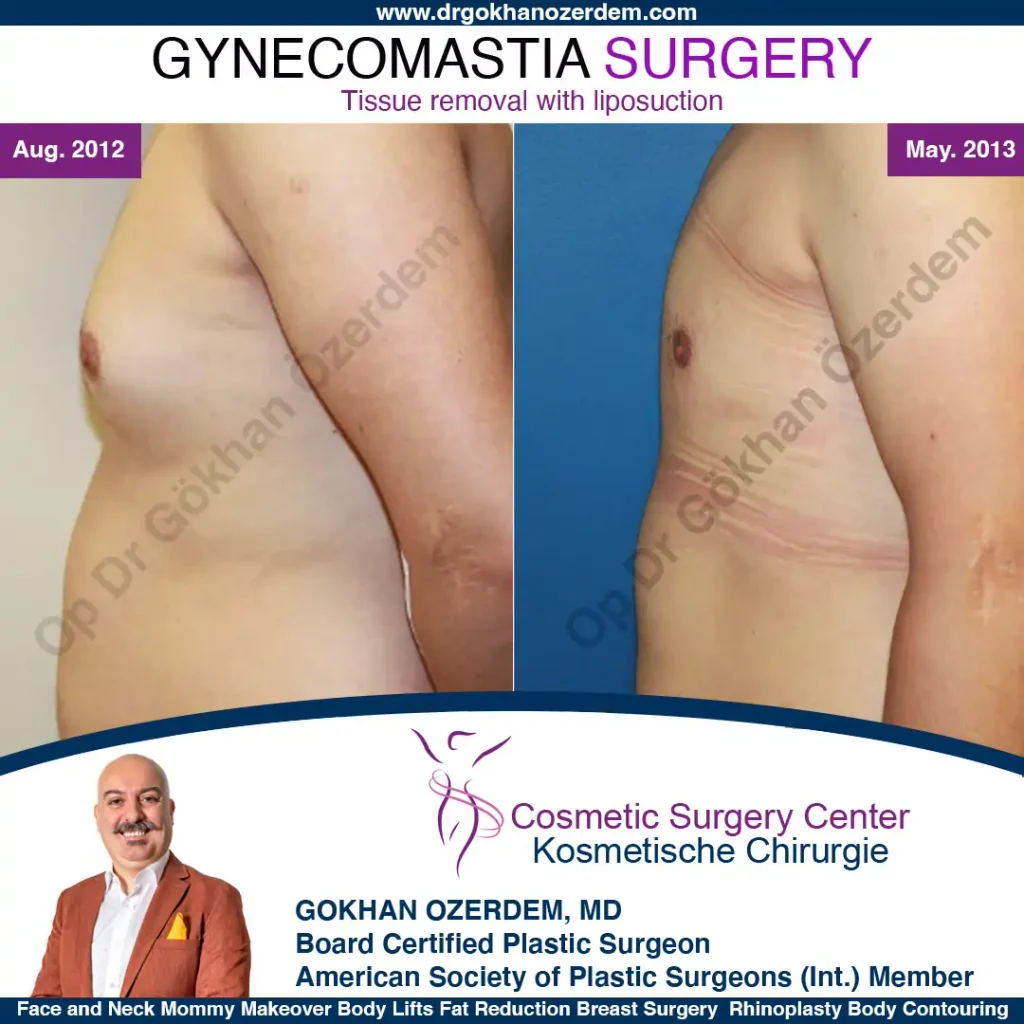 Gynecomastia in Turkey, Case 5 - Left Side