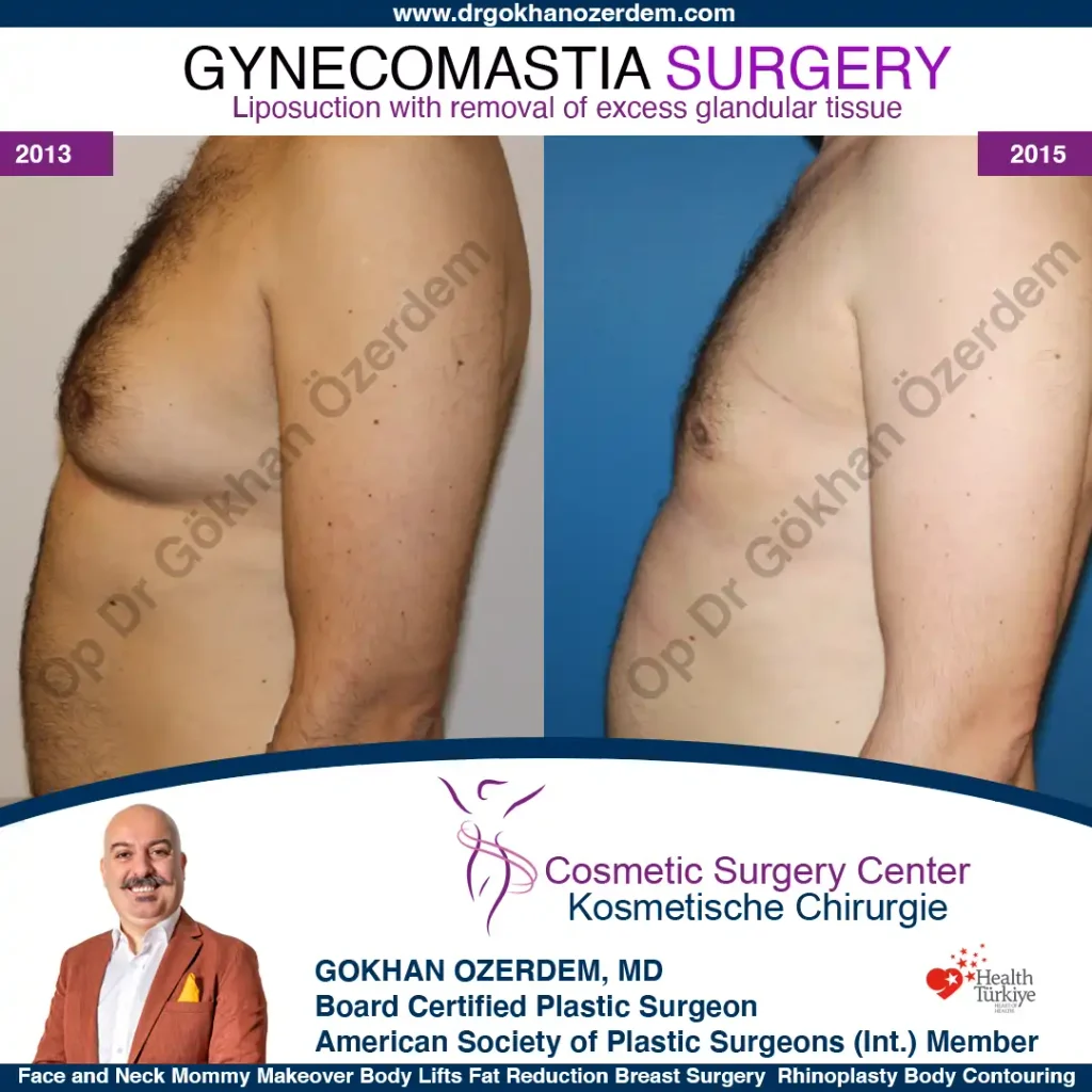 Gynecomastia in Turkey, Case 4 - Left Side
