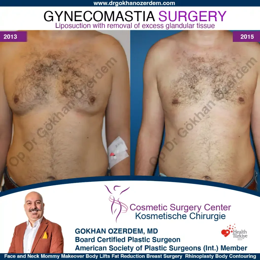Gynecomastia in Turkey, Case 4 - Front Side