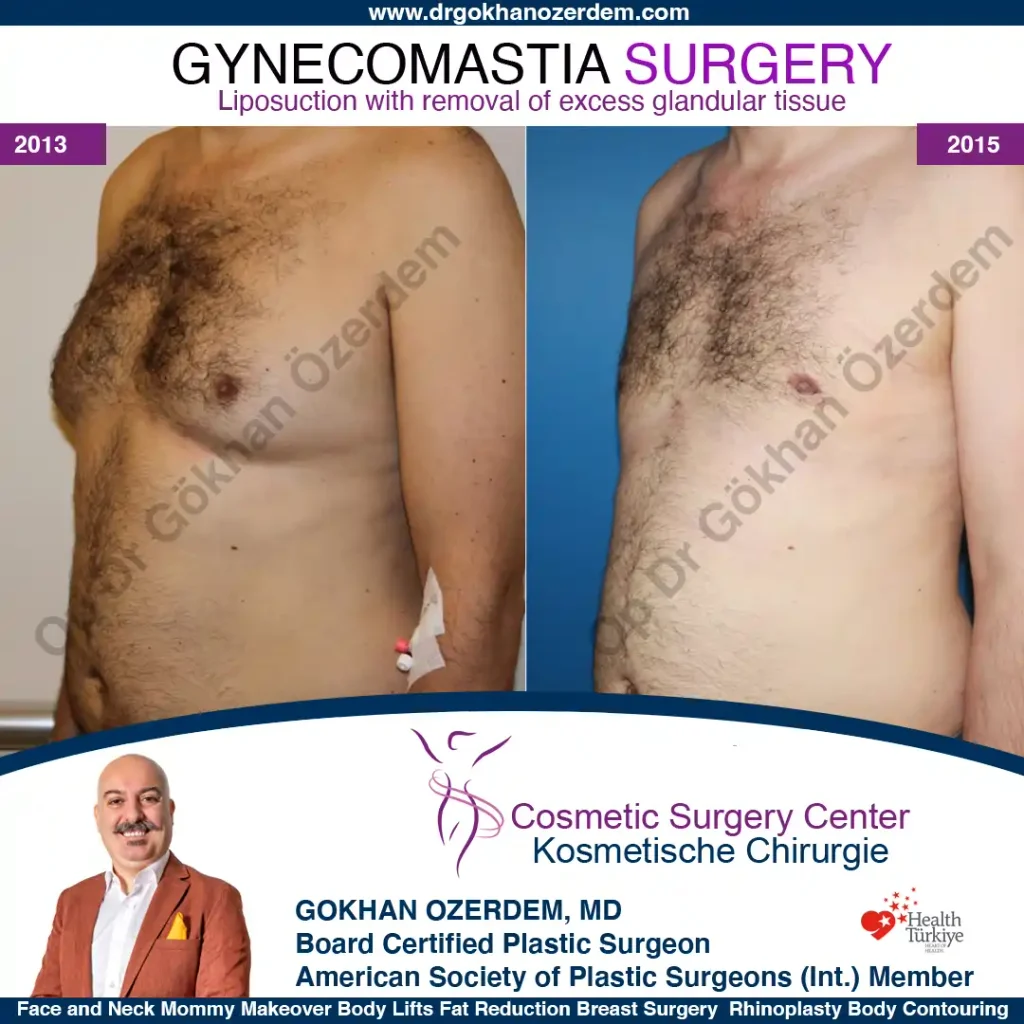 Gynecomastia in Turkey, Case 4 - Oblique View