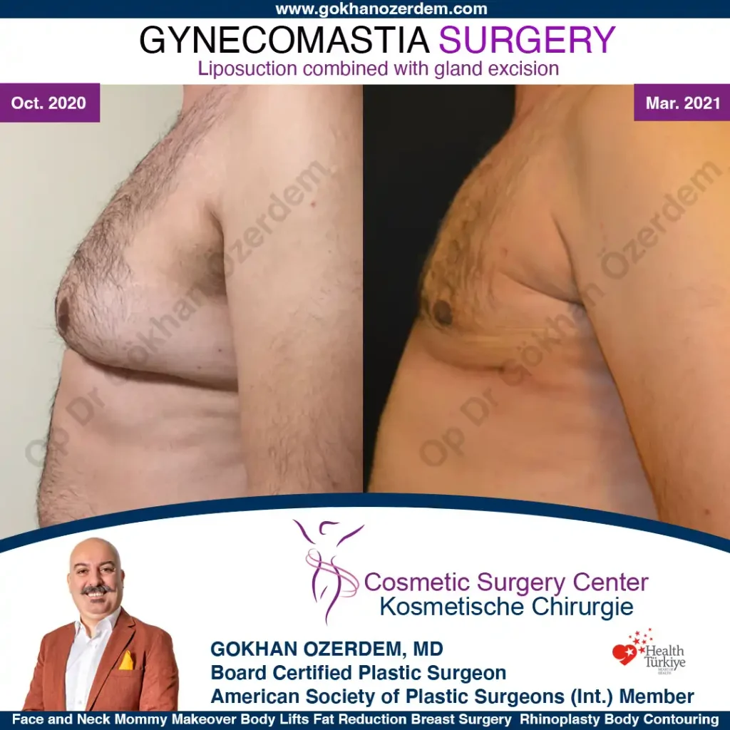 Gynecomastia in Turkey, Case 3 - Left Side