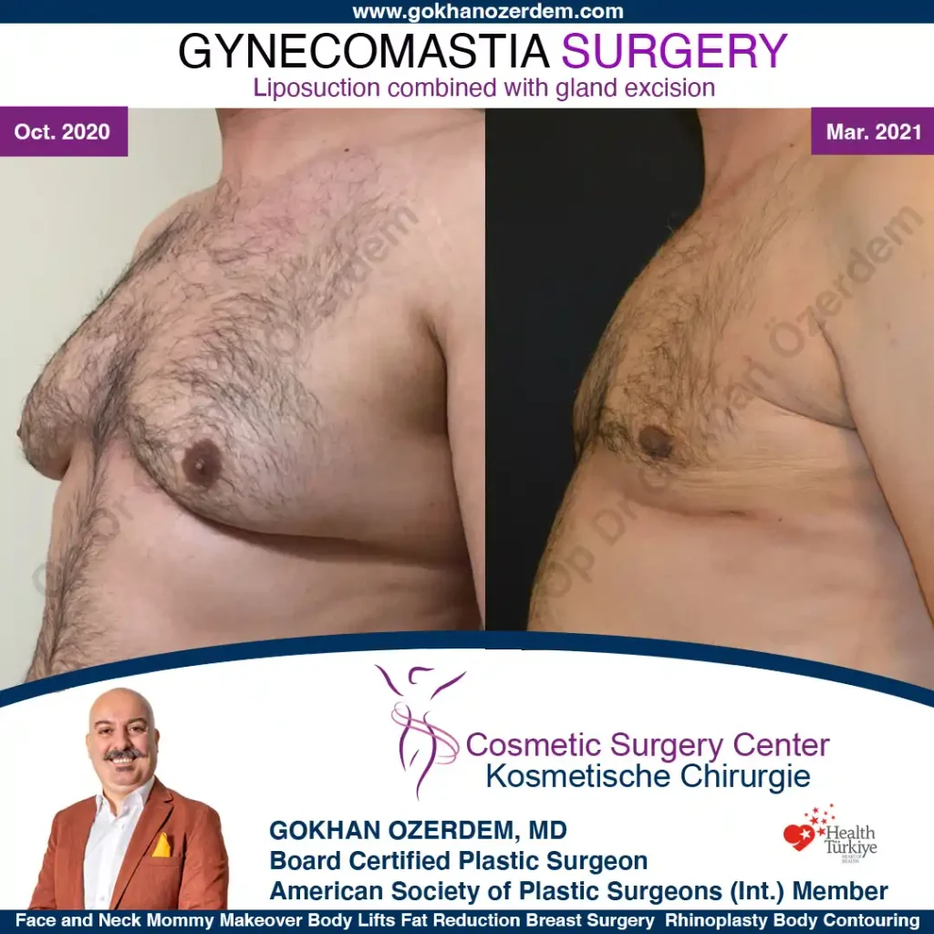 Gynecomastia in Turkey, Case 3 - Oblique View