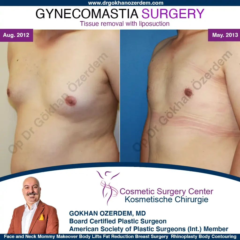 Gynecomastia in Turkey, Case 5 - Oblique View