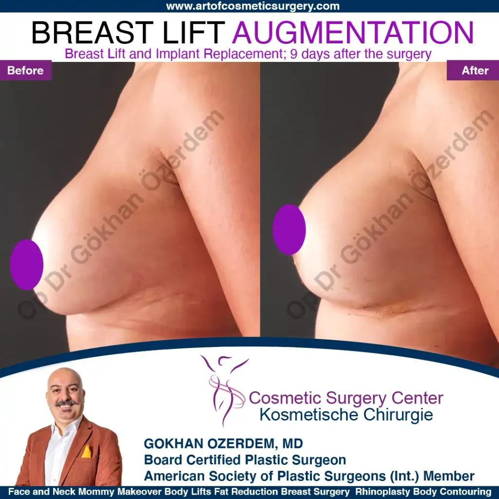 Breast Augmentation in Turkey - Case 29 - Left View