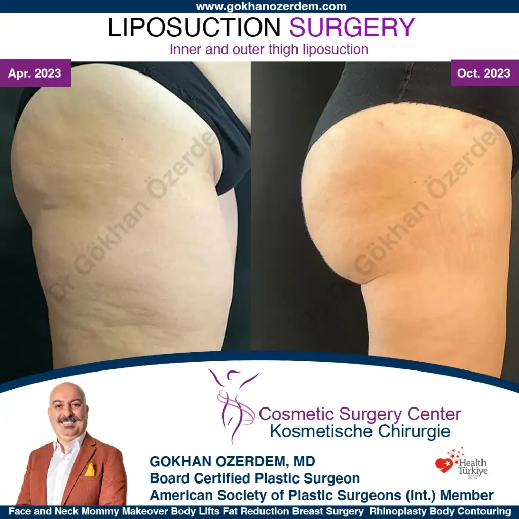 Thigh liposuction in turkey, Antalya - Case 6 - Right Side View