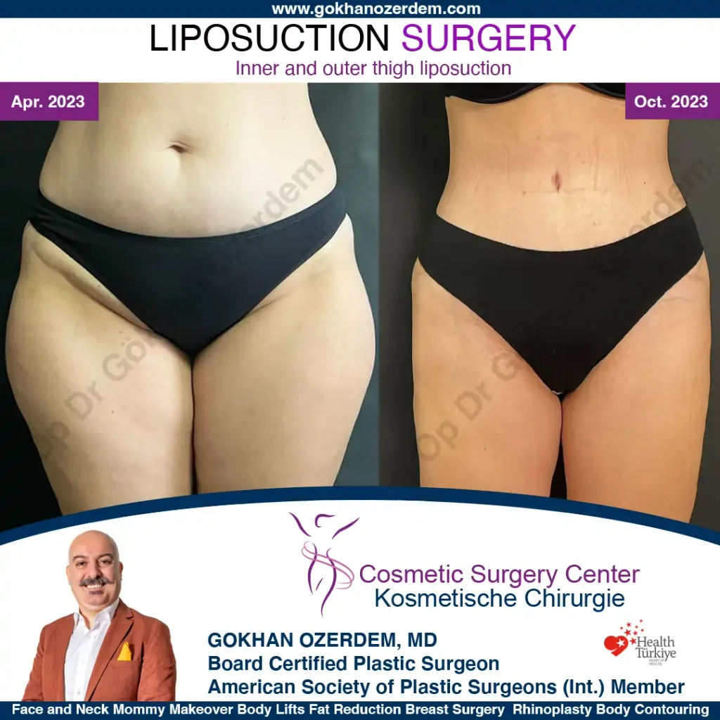 Thigh liposuction in turkey, Antalya - Case 6 - Front View