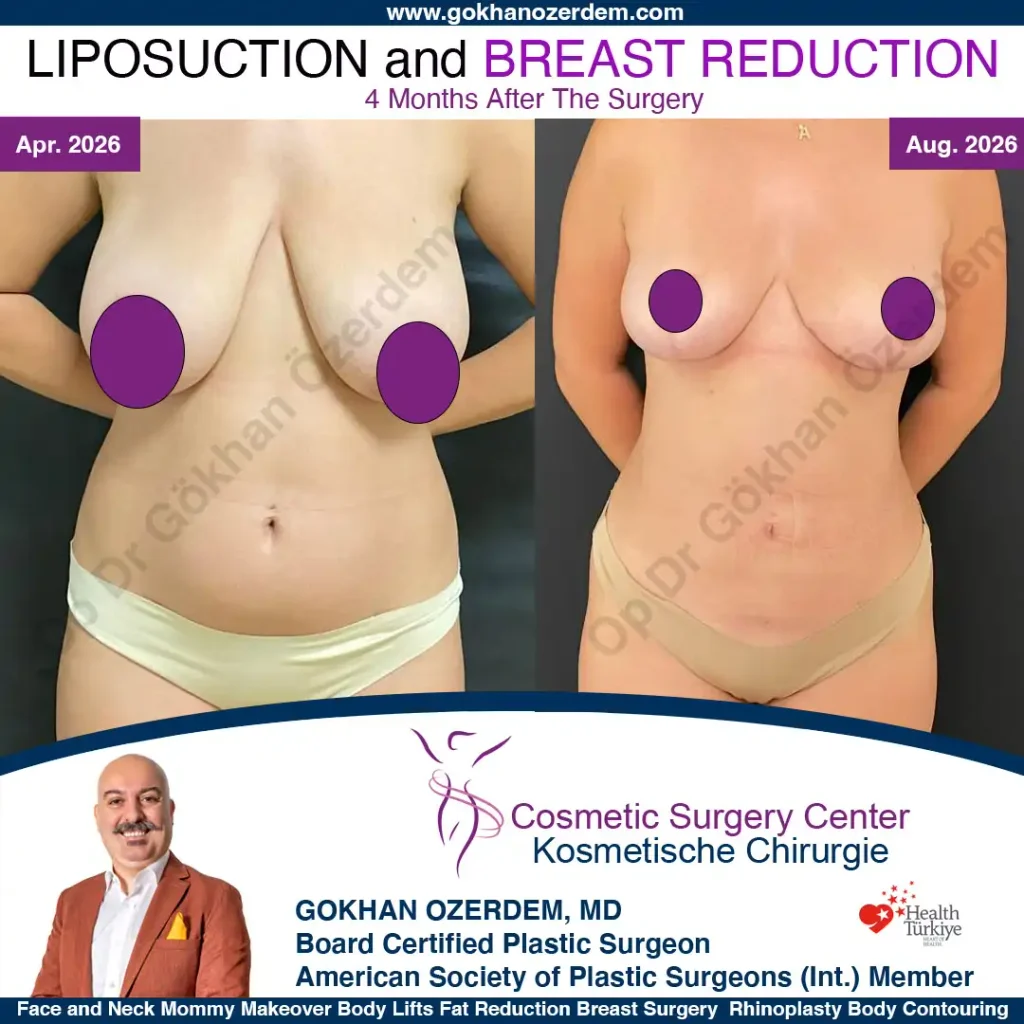 Breast Reduction in Turkey, Case 1 - Front View