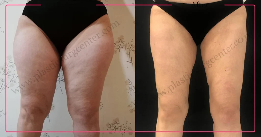 Leg Liposuction in Turkey - Case 3 - Front view