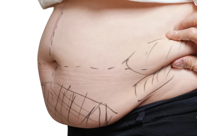 Liposuction in Turkey Antalya Dr Gökhan Ozerdem