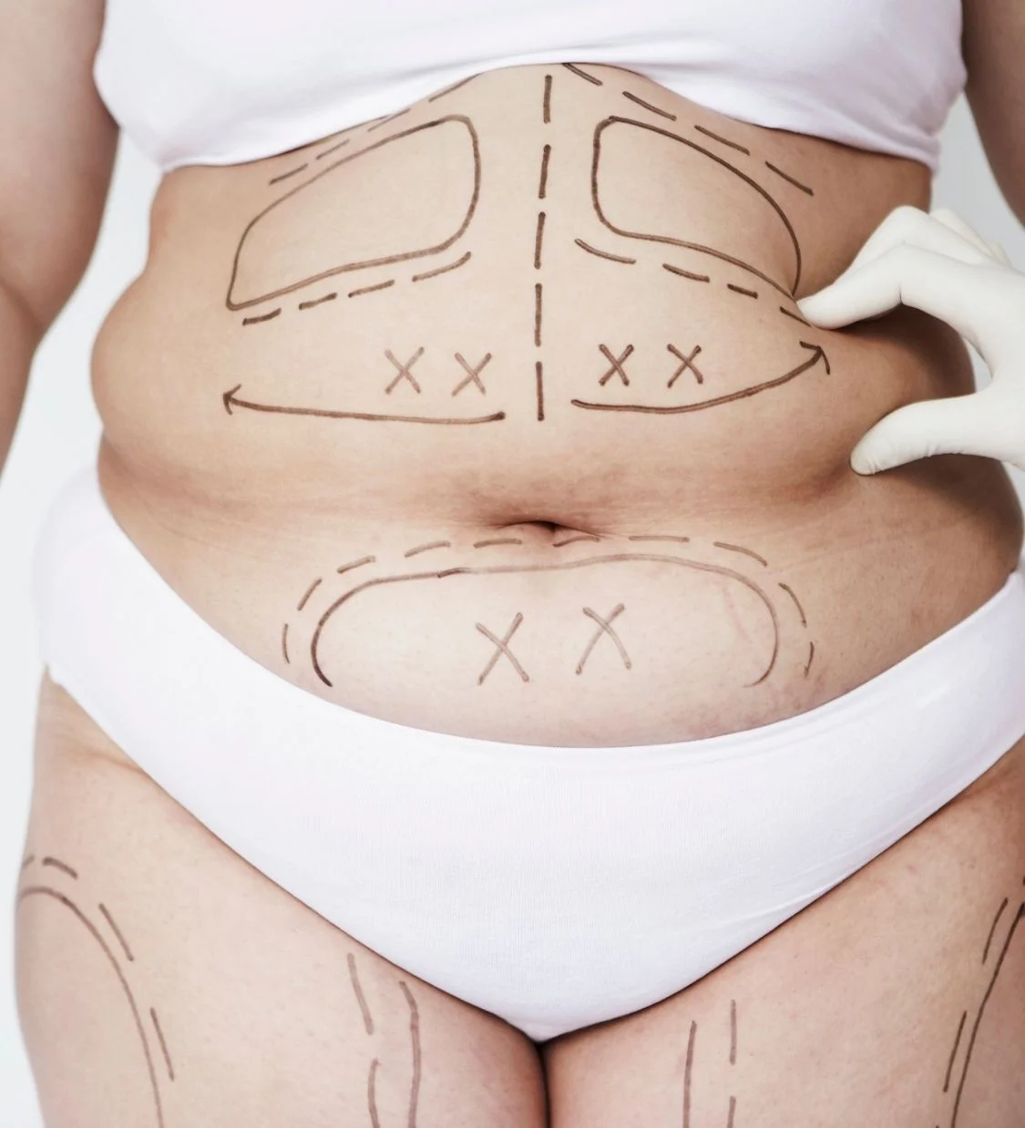 Liposuction in Turkey, Antalya