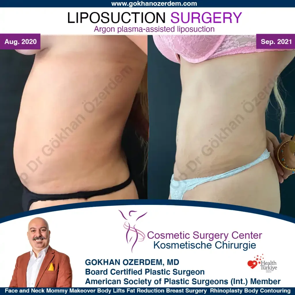 Liposuction in Turkey - Case 2 - Front view - Left Side