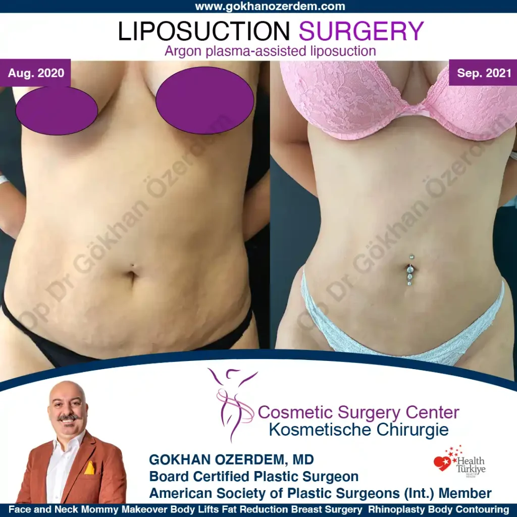 Liposuction in Turkey - Case 2 - Front view - Before After