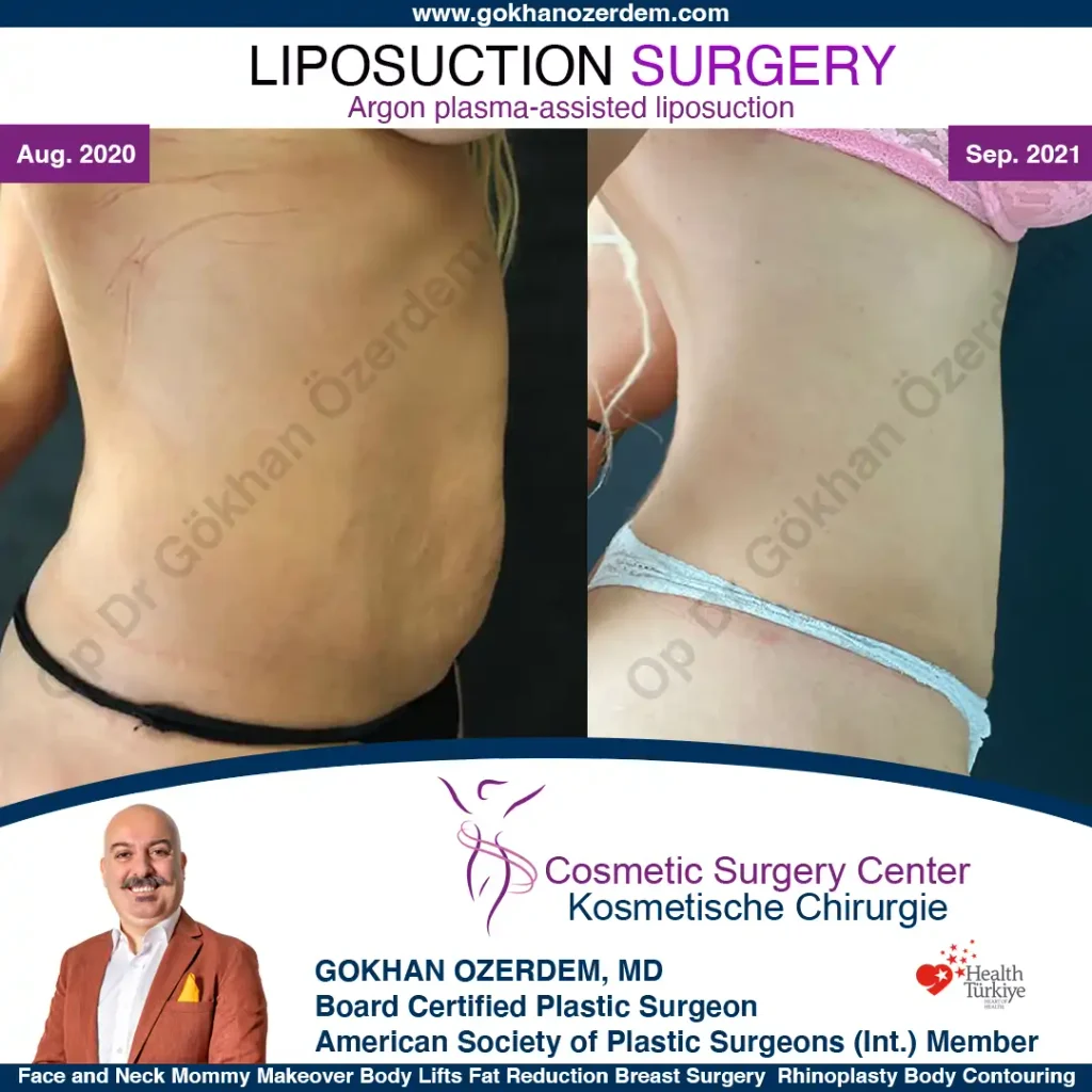 Liposuction in Turkey - Case 2 - Front view - Right Side